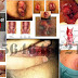 Anus Berdarah Ketika Berak atau Buang Air Besar thumbnail