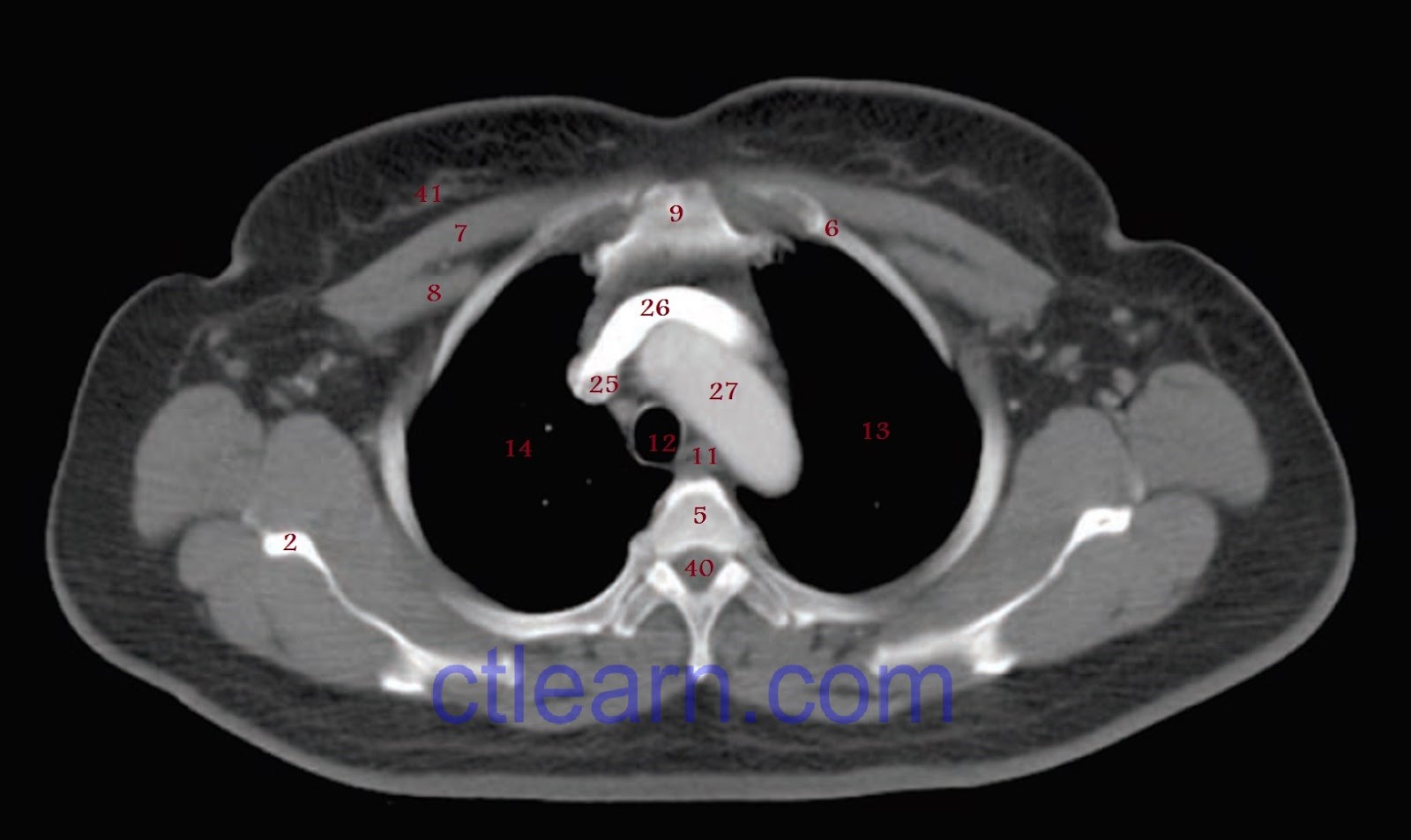 Labeled Chest CT Scan Anatomy