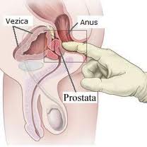 remedii populare pentru prostatita sangerari dupa operatie de prostata