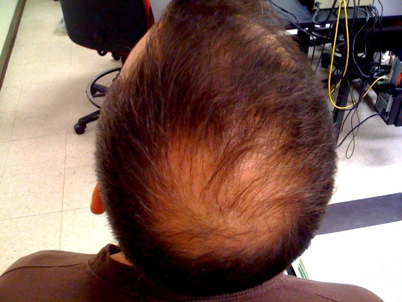diffuse type of alopecia
