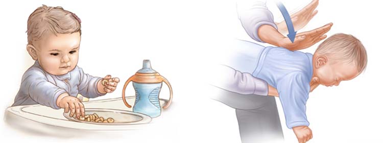 atragantamiento bebe