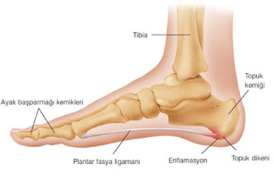 topuk dikeni nedir nasil tedavi