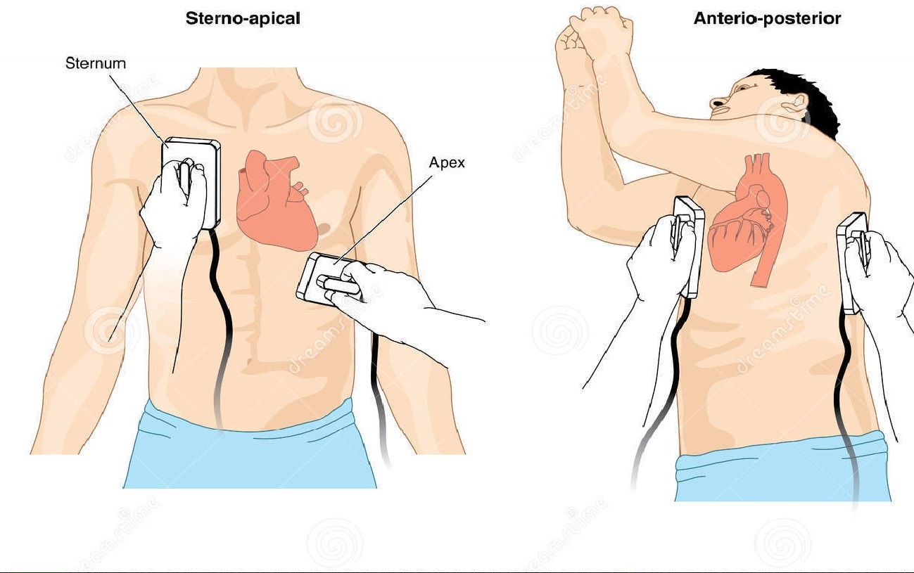 The Site for Healthcare Professionals Defibrillator