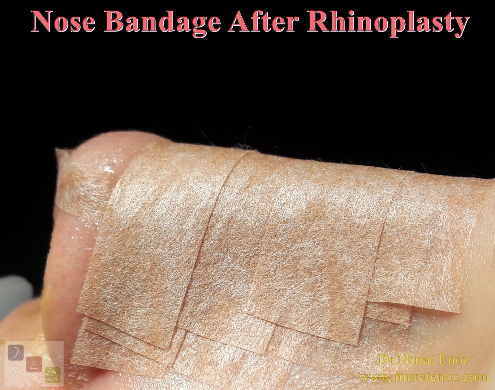 Health Zone Turkey Frequently Asked Questions (FAQ) About Rhinoplasty Operation in Istanbul