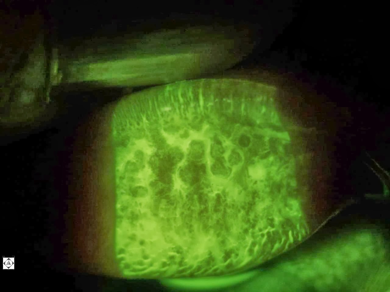 GIANT PAPILLARY CONJUNCTIVITIS GPC Sonoran Desert Eye Center giant-papillary-conjunctivitis-gpc-sonoran-desert-eye-center