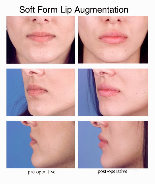 Увеличение головки гиалуроновой кислотой цена в москве до и после Увеличение головки гиалуроновой кислотой цена в москве до и после