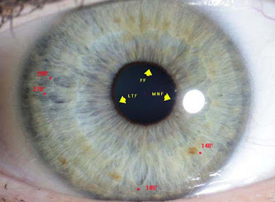 double pupil wikipedia double pupil wikipedia