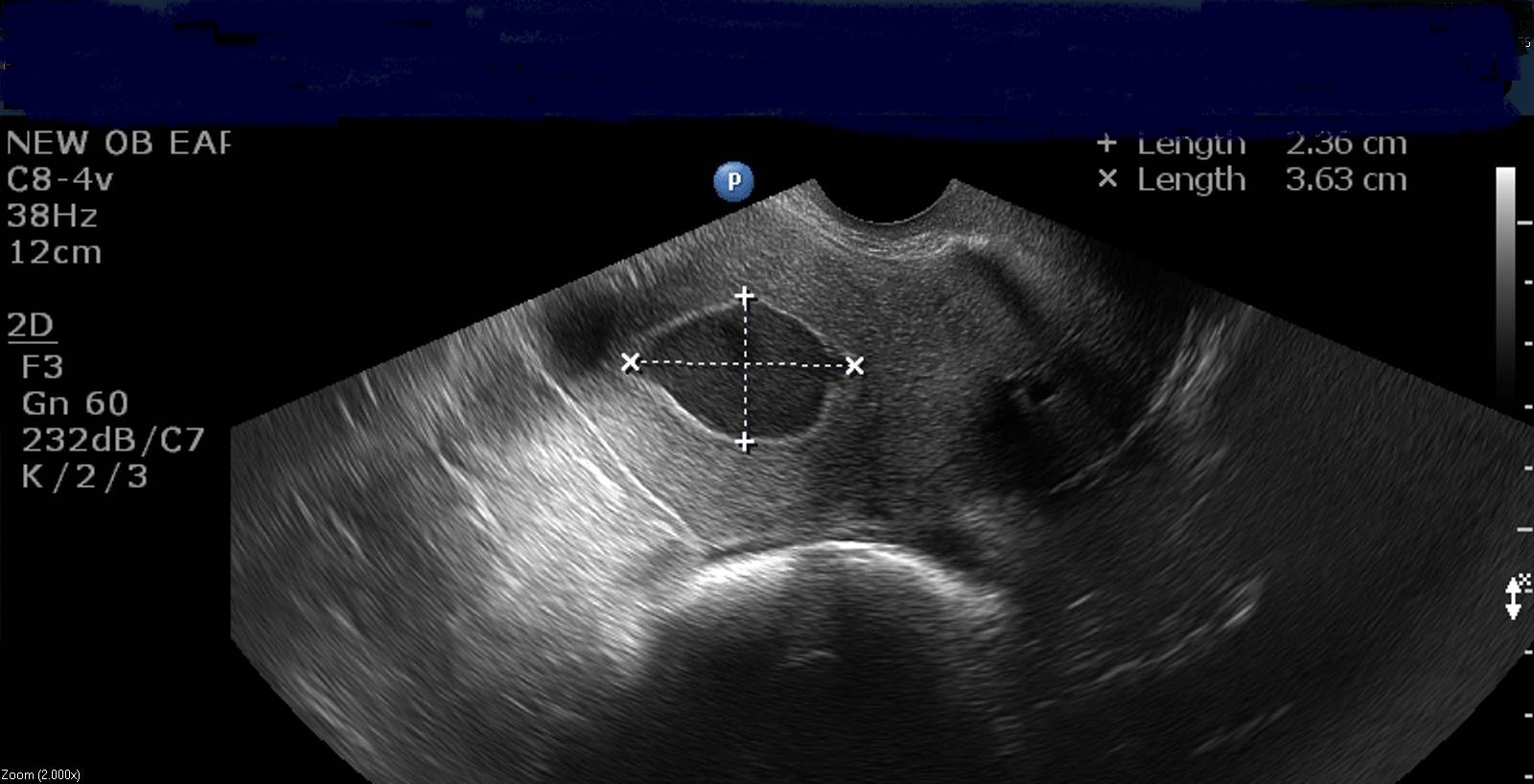 Hematometra Pictures Blood Trapping By The Uterus
