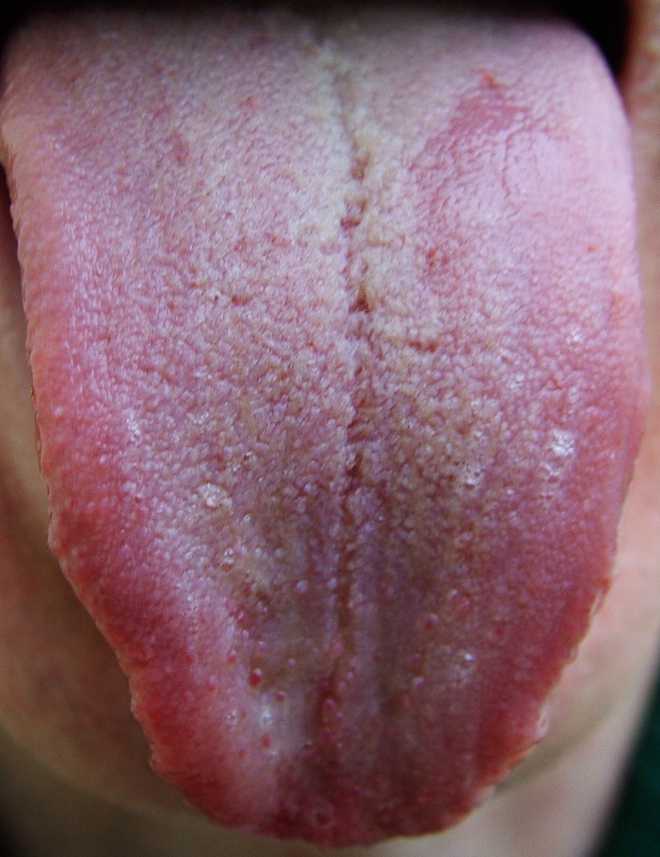 Dry Mouth And White Tongue 81