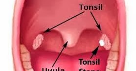 Get Rid Of Tonsil Stones Naturally Without Surgery Get Rid Of Tonsil Stones Naturally Without Surgery