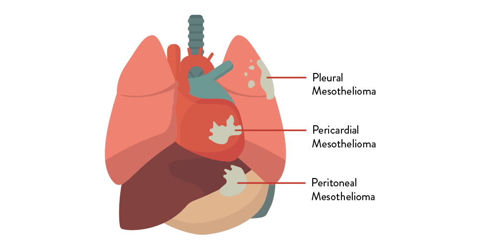 Mesothelioma of the peritoneum