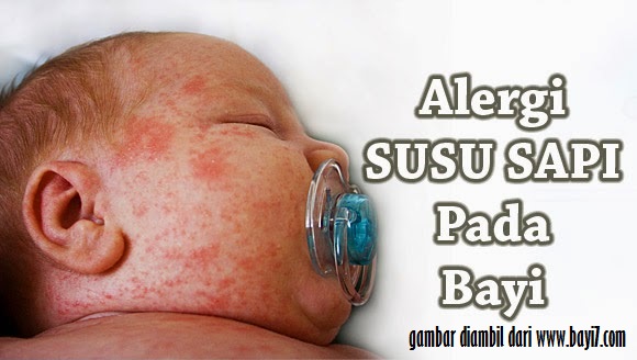 Bayi Alergi Susu - Blog Mas Hendra 