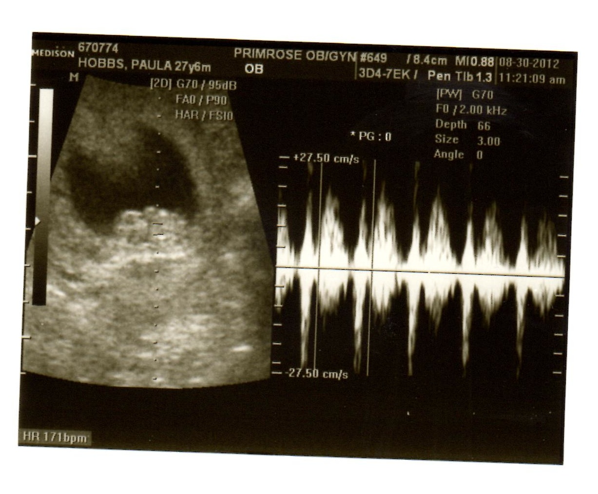 Three For the Price of One My Triplet Pregnancy 3 Little Gummy Bears )