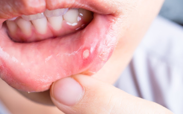 Get Rid Of Cold Sore and Cancer Sore