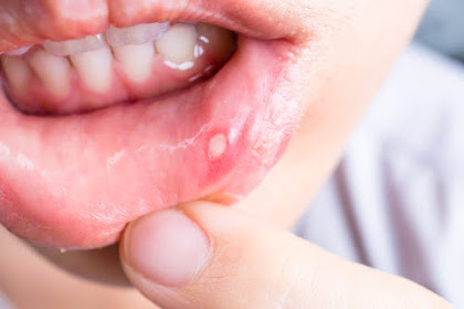 Get Rid Of Cold Sore and Cancer Sore