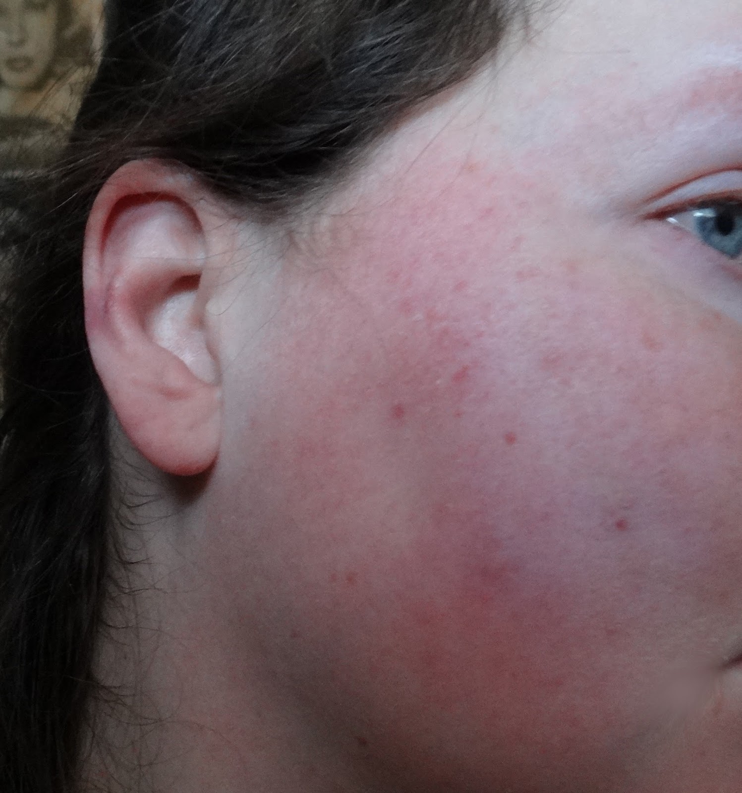 Scarlet Letters, dealing with vascular rosacea, face flushing, burning