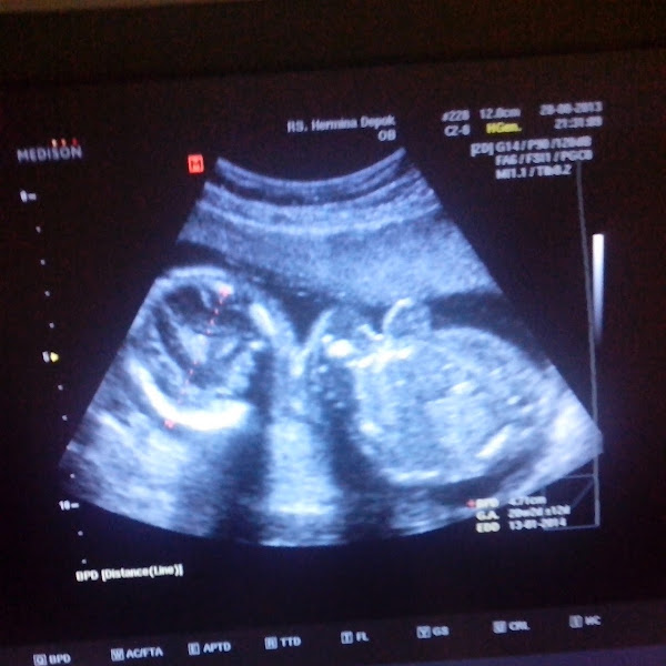 Baby Girl or Baby Boy?