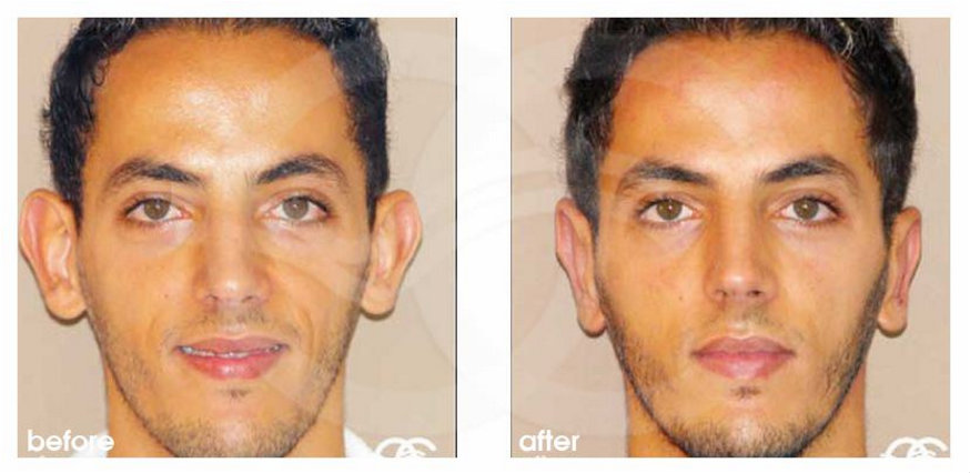 Plastic And Cosmetic Surgery Let Your Confidence Stick Out Not Your Ears  plastic-and-cosmetic-surgery-let-your-confidence-stick-out-not-your-ears