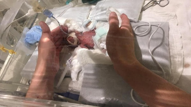 Terlahir Prematur dengan Bebobot 268 Gram, Bayi Ini Berhasil Diselamatkan Tim Medis