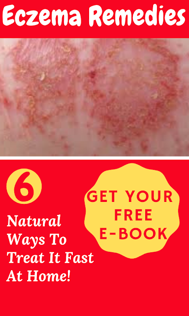 Natural Ways To Treat Eczema Fast At Home