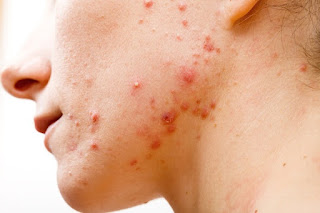 Acne Vulgaris Definition