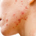 Acne Vulgaris Definition And Causes