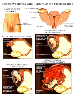 ectopic pregnancy