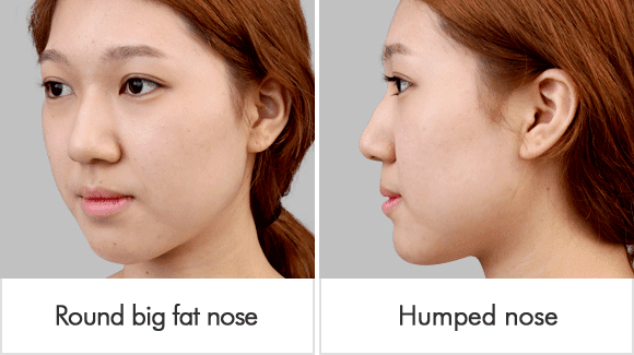 real story through korean celebrities rhinoplasty my nose became