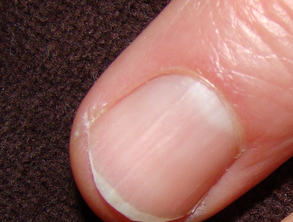 Fingernails can offer clues to health problems ...