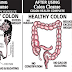 How To Flush Out Toxins From Stomach To Avoid Colon Cancer!!!