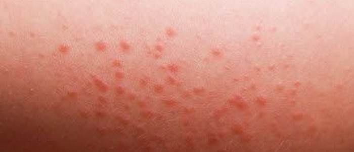 Skin Rashes Identification Pictures
