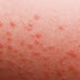 Pictures Of Rashes And Skin Rashes Photos