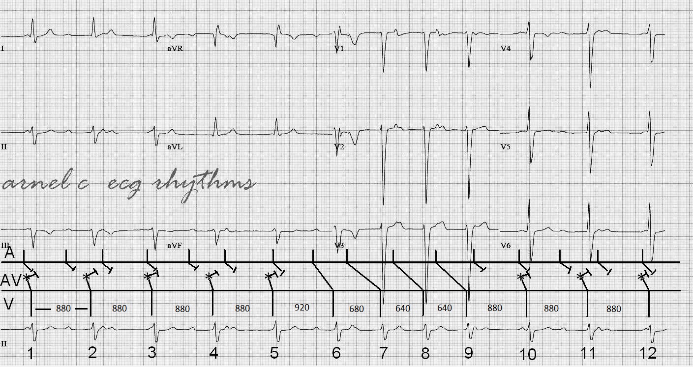 ECG Rhythms Is this Complete Heart Block?