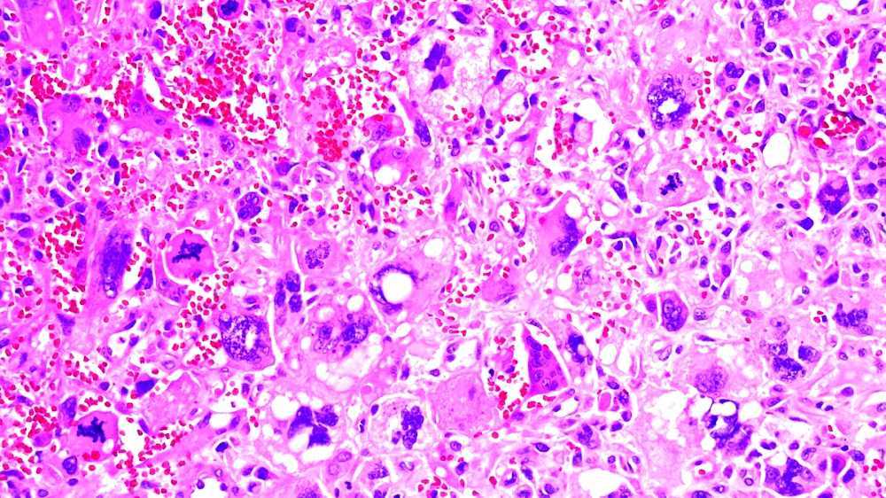 Giantcell carcinoma of the lung
