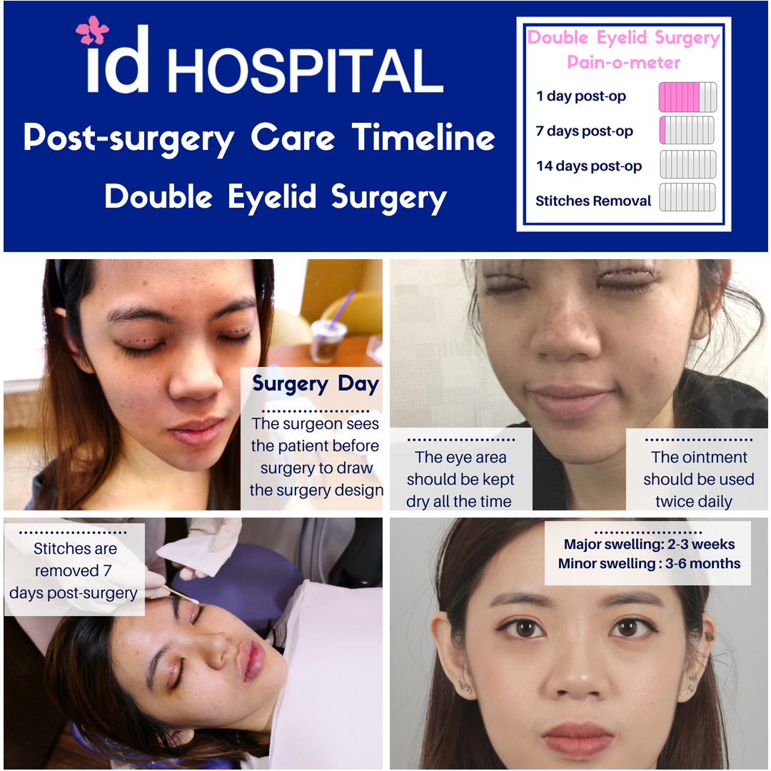 ID Hospital Korea: Eyelid surgery recovery process, tips & photos