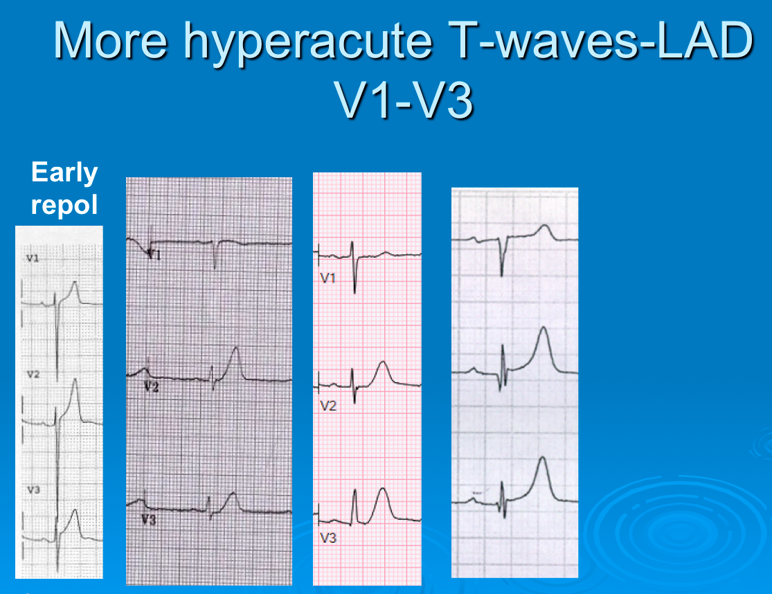Dr. Smith's ECG Blog Large Twaves and a Computer Interpretation of