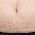Simple But Very Effective Ways To Remove Stretch Marks After Pregnancy