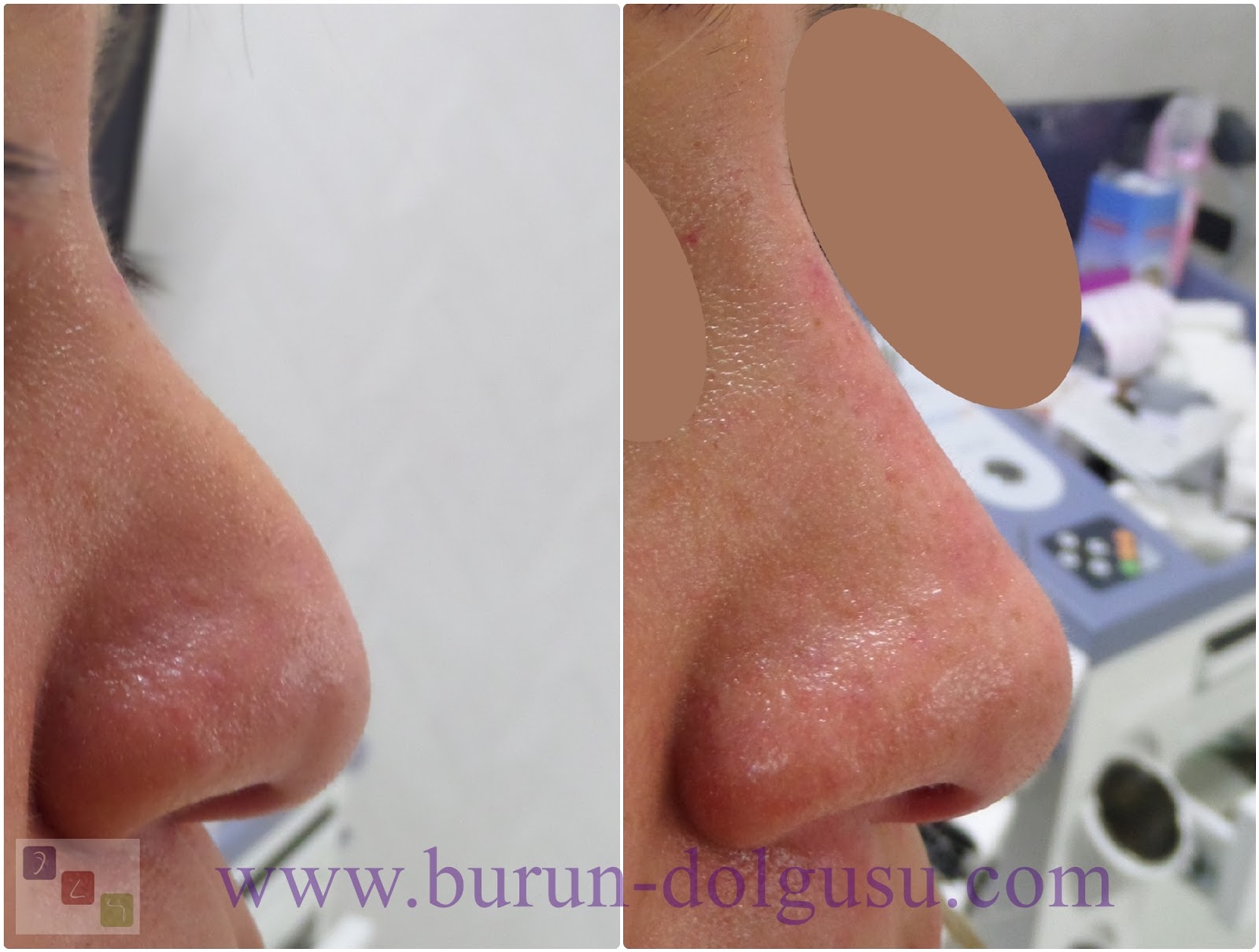 Burun Dolgusu Fiyati 2020 Guncellendi