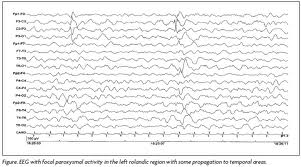 Usaha Rawatan Arif 2 ~ Ujian EEG - Elektroensefalograf 