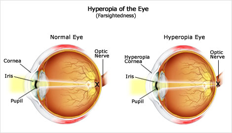 dioptriák látása hogyan lehet visszaállítani a fekete látást