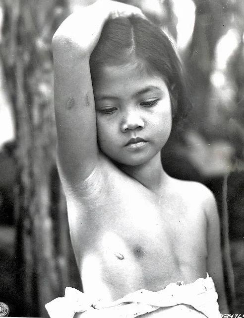 A young girl from Lipa in 1945 shows off scars from Japanese atrocities.  Image source:  United States National Archives.