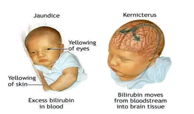 Seminar Report On Haemolytic Disease Of The New-Born ...