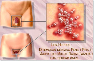 pengobatan herpes pengobatan herpes