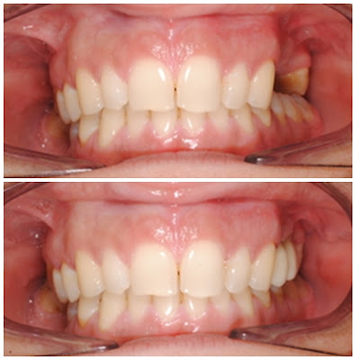 implantes de dentes