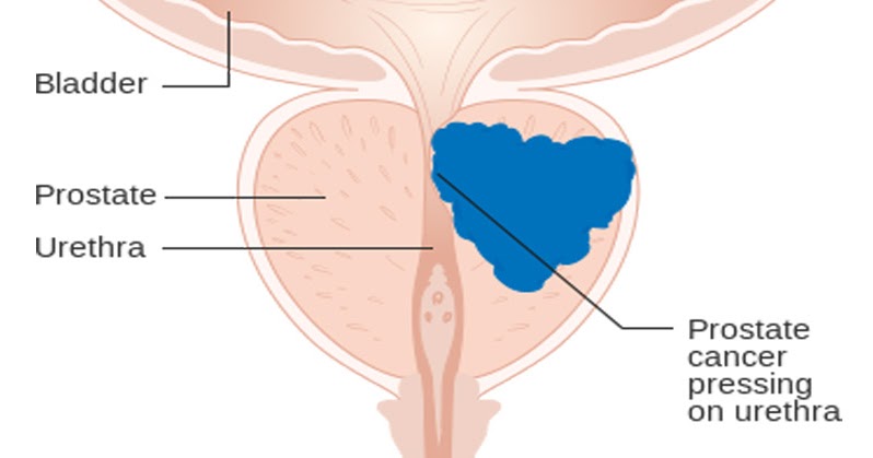 Pdf Sexual Activity And The Risk Of Prostate Cancer