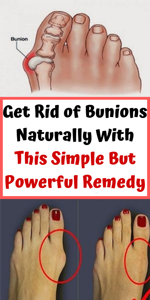 Let Start Slim Today Get Rid of Bunions Naturally With This Simple But