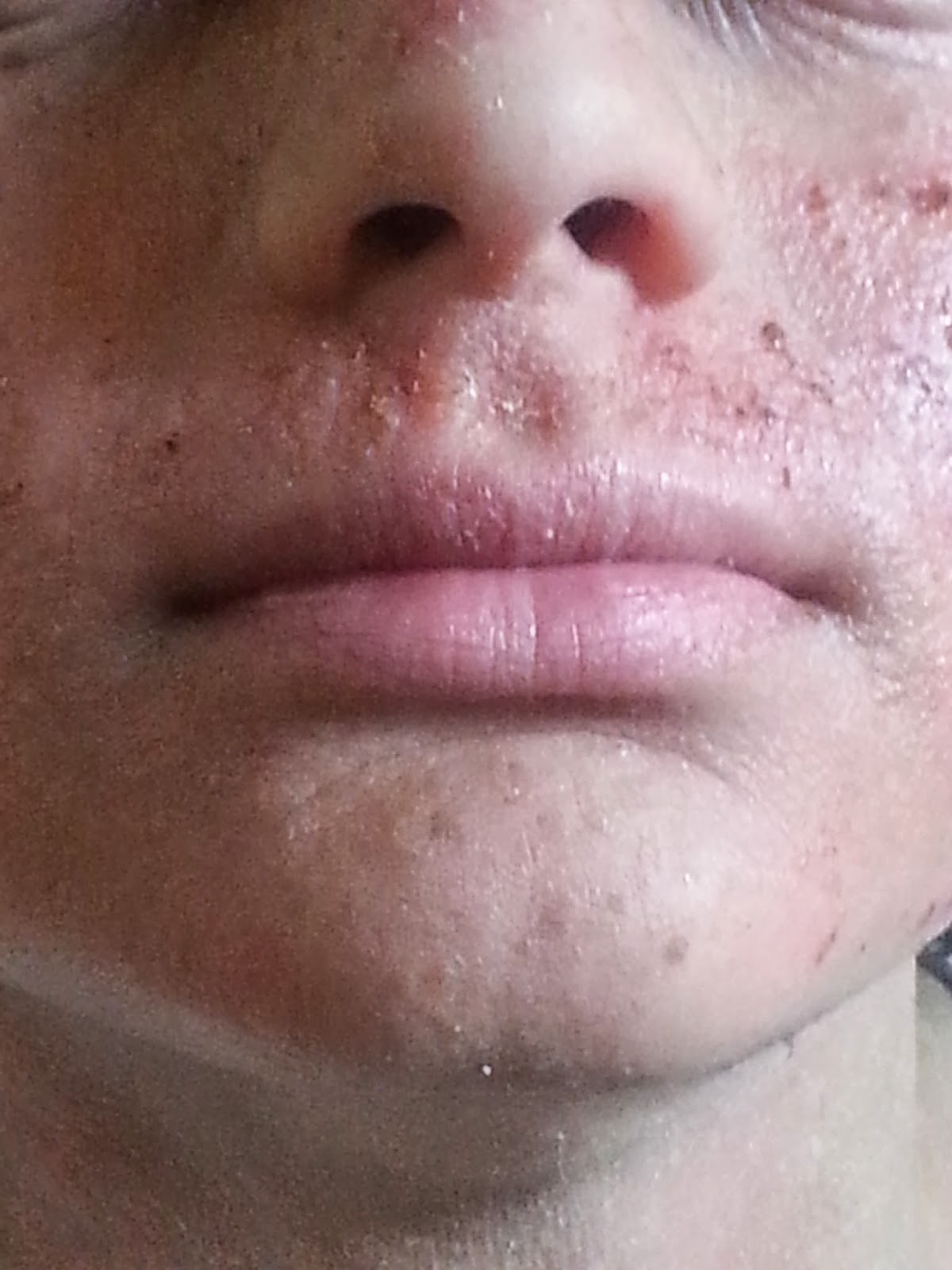 Steroids Make Eczema Worse