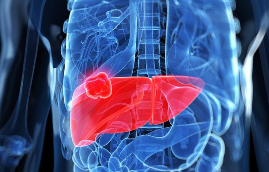 Metastatic Liver Cancer Survival Rate