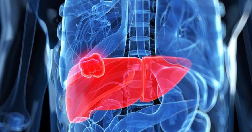 Metastatic Liver Cancer Survival Rate CancerOz
