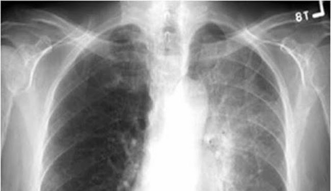 小細胞肺癌 標靶藥不適用